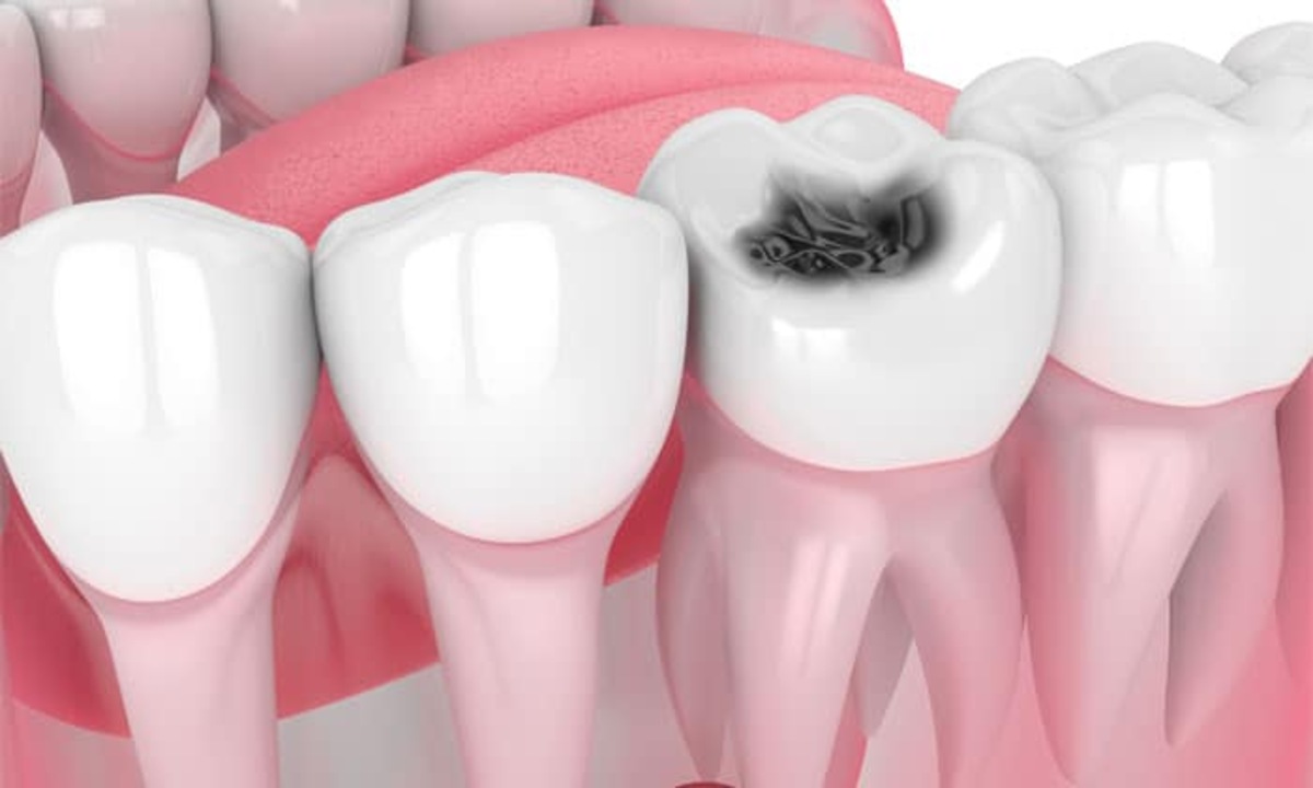 Does tooth decay hurt? Do this simple to get relief from dental problems.
