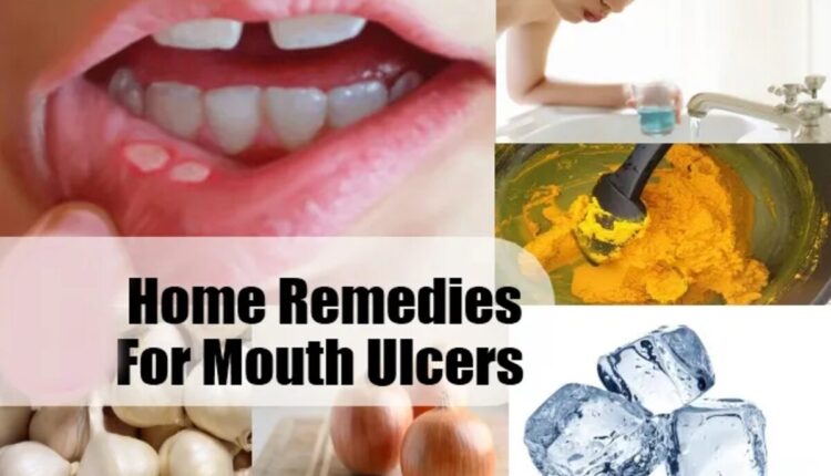 Mouth Ulcer: If the mouth is not taken care of, the same thing happens; Natural methods to cure mouth ulcers